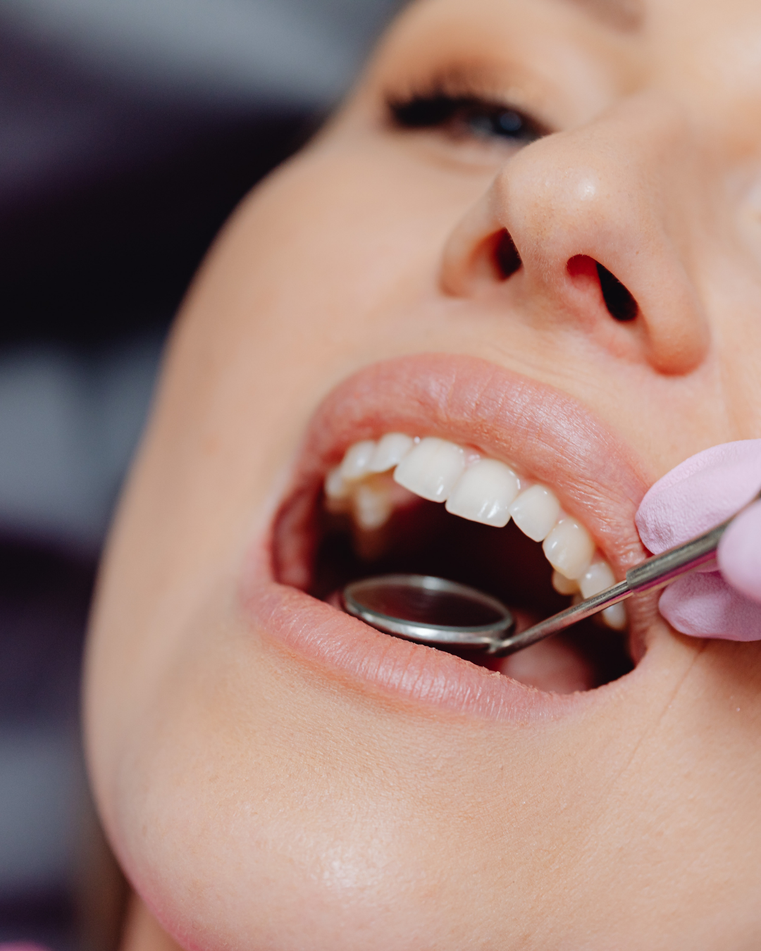 Diş Taşı Temizliği Nedir?